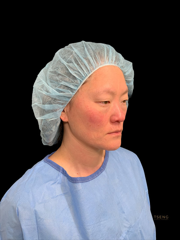 Eyelid Surgery Before & After Image