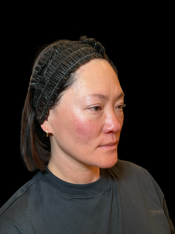 Eyelid Surgery Before & After Image