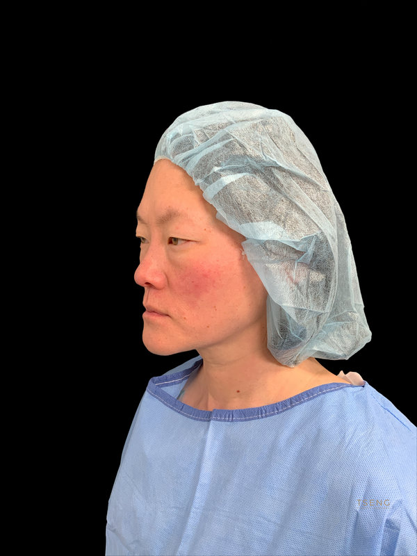 Eyelid Surgery Before & After Image