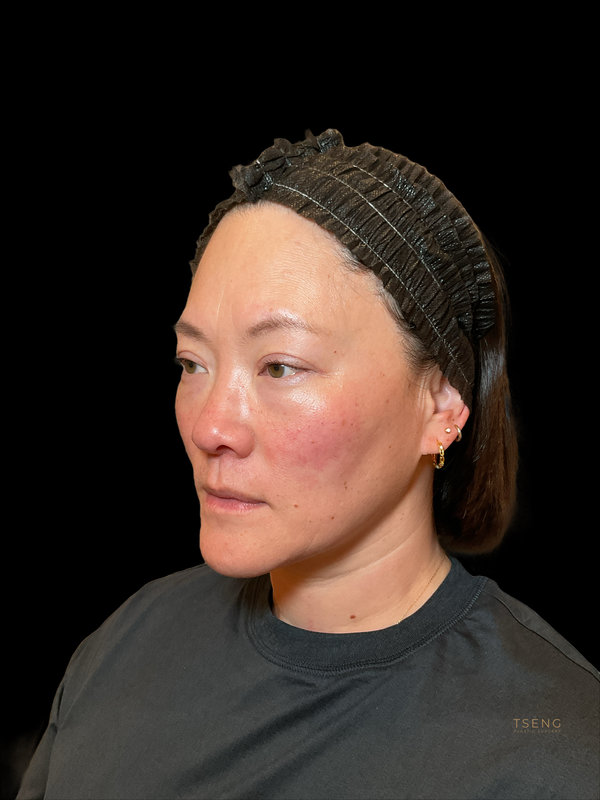 Eyelid Surgery Before & After Image