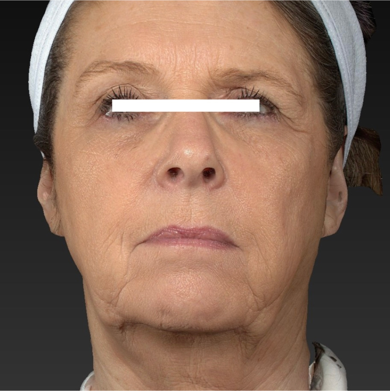 Facelift Before & After Image