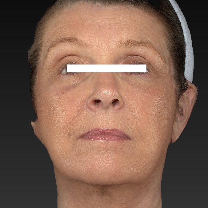 Facelift Before & After Image