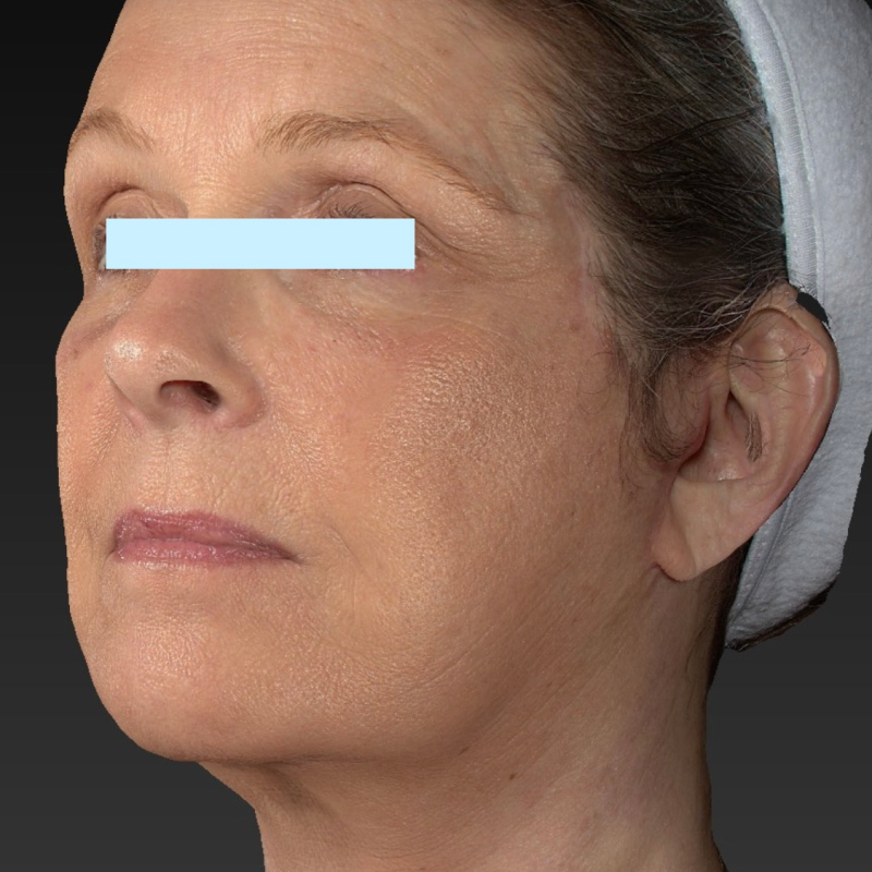 Facelift Before & After Image