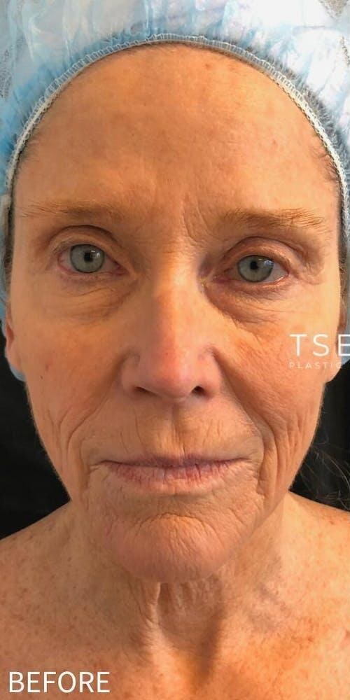 Facelift Before & After Image