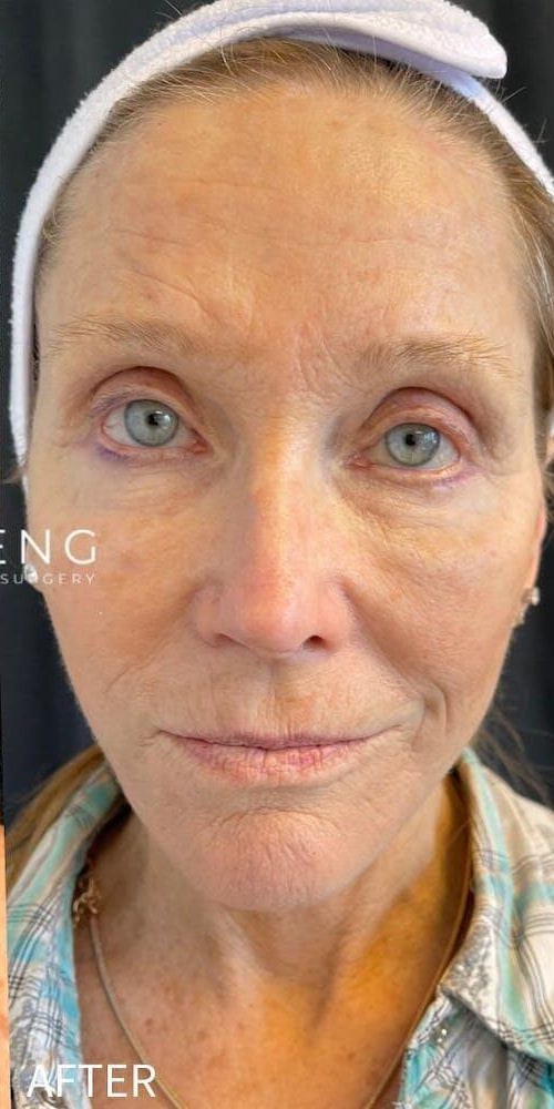 Facelift Before & After Image