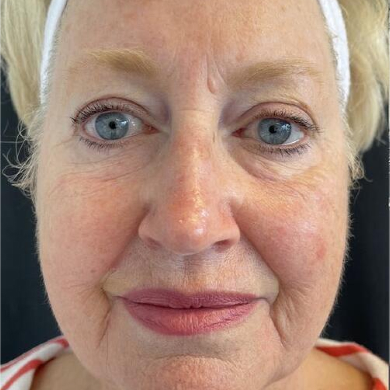 Facelift Before & After Image