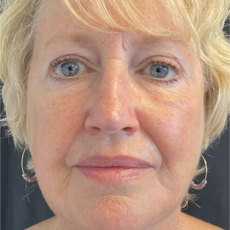 Facelift Before & After Image