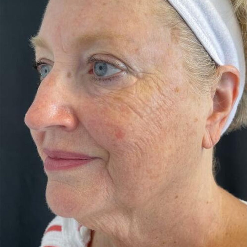 Facelift Before & After Image