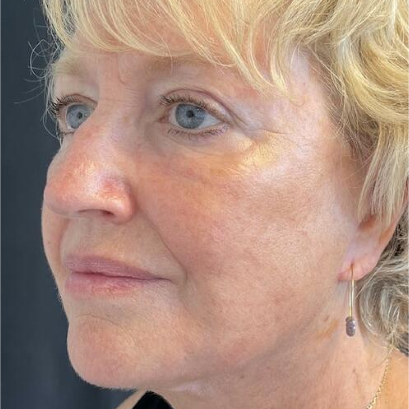 Facelift Before & After Image