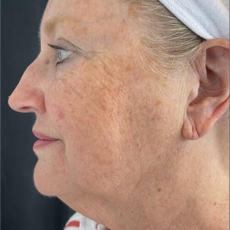 Facelift Before & After Image