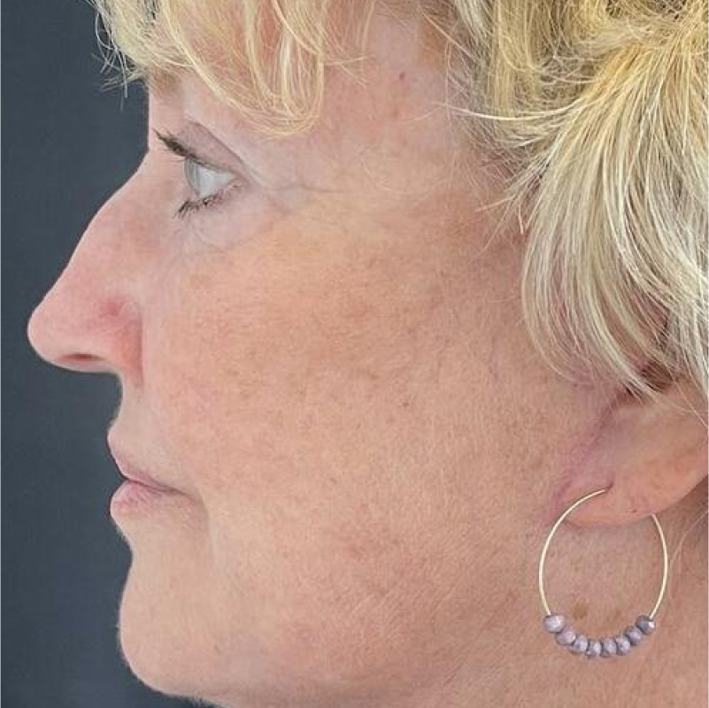 Facelift Before & After Image