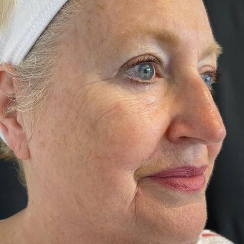 Facelift Before & After Image