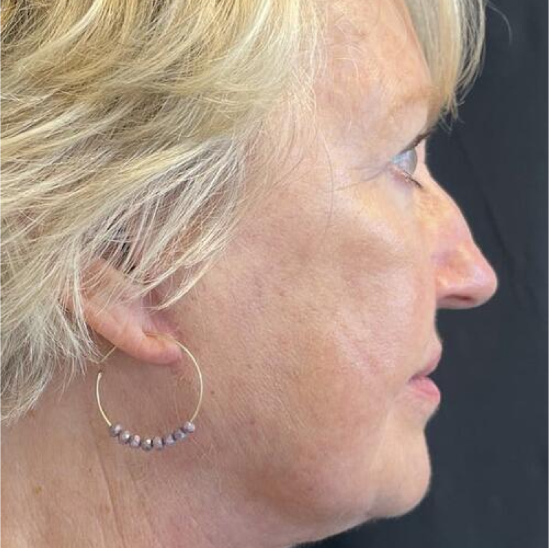 Facelift Before & After Image