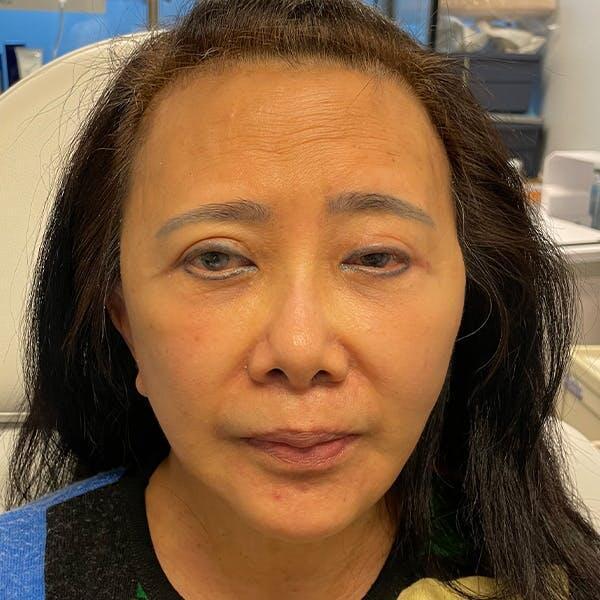 Facelift Before & After Image