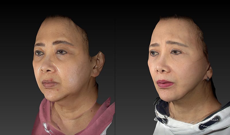 Facelift Before & After Image