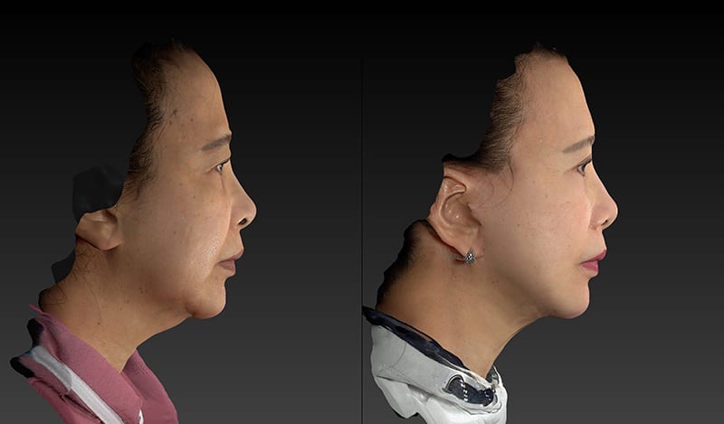 Facelift Before & After Image