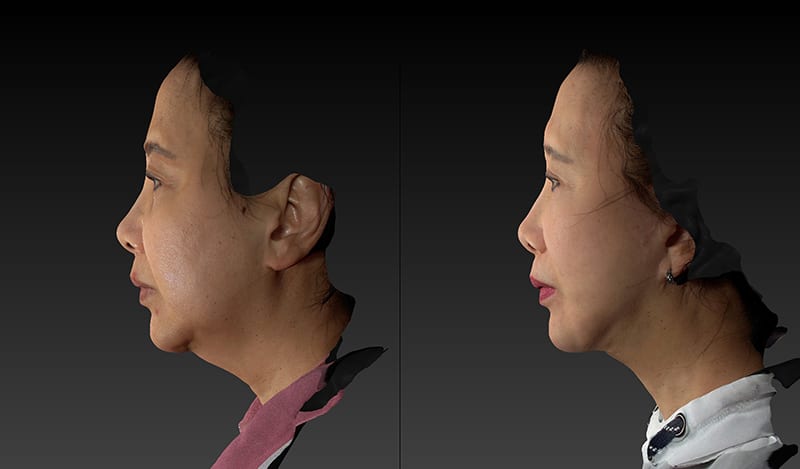 Facelift Before & After Image