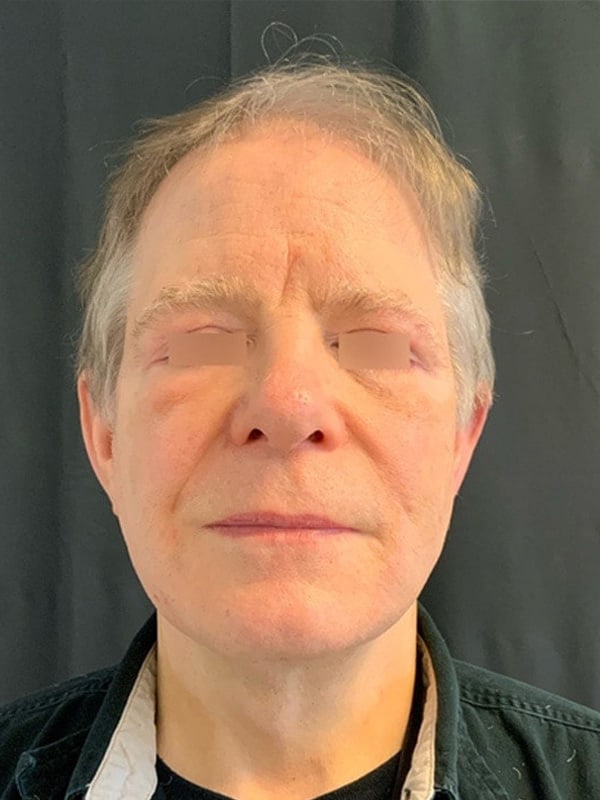 Facelift Before & After Image