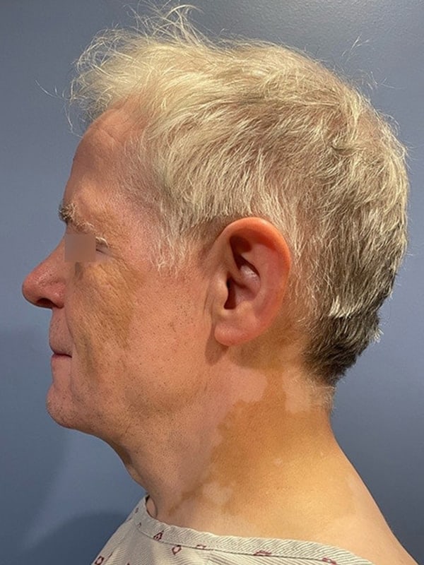 Facelift Before & After Image