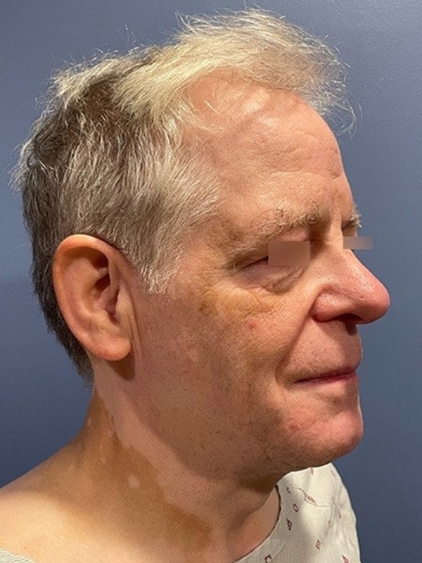 Facelift Before & After Image