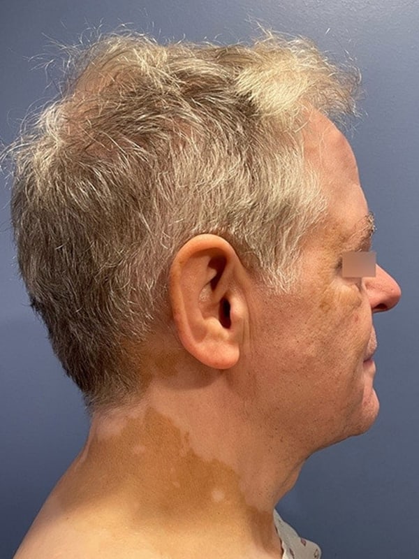 Facelift Before & After Image