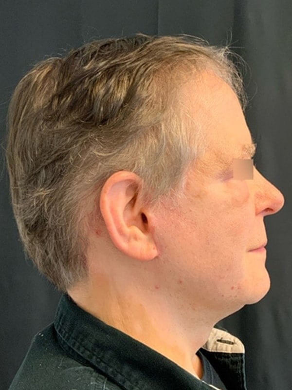 Facelift Before & After Image