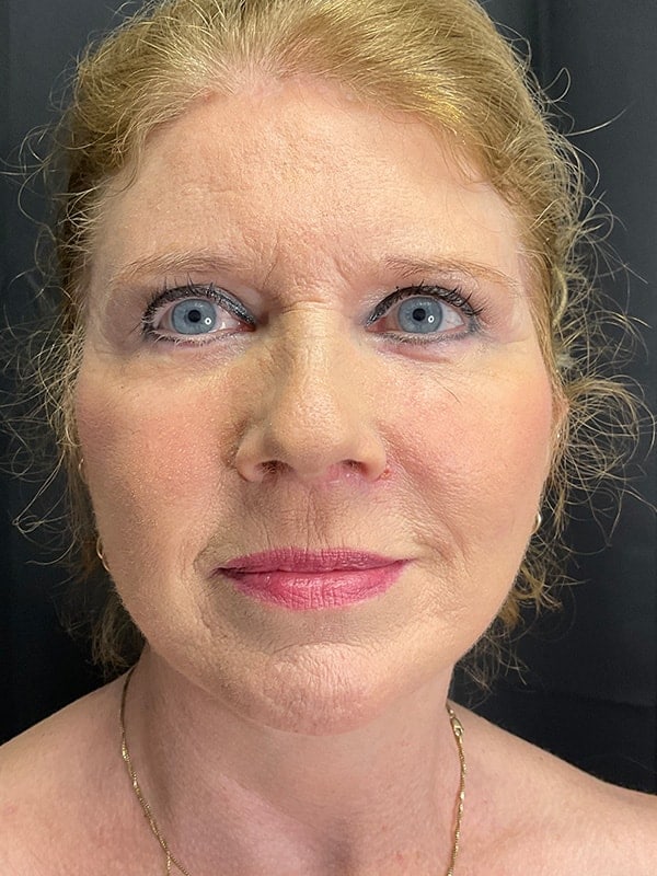 Facelift Before & After Image