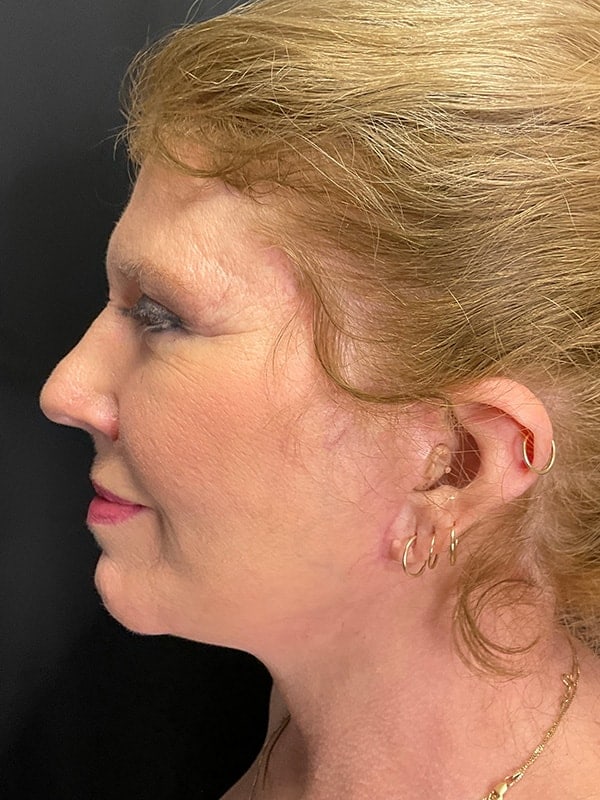 Facelift Before & After Image