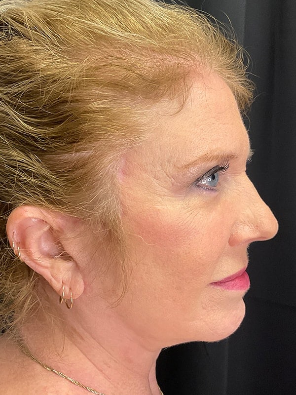 Facelift Before & After Image