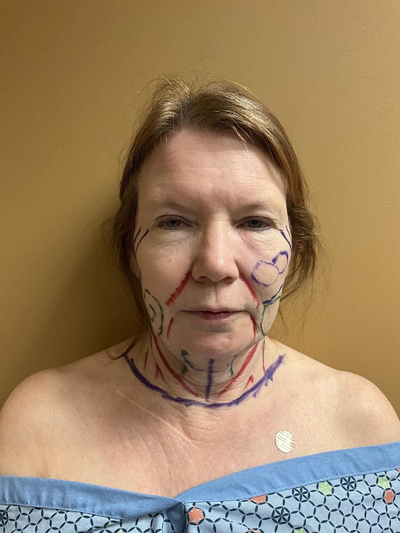 Facelift Before & After Image