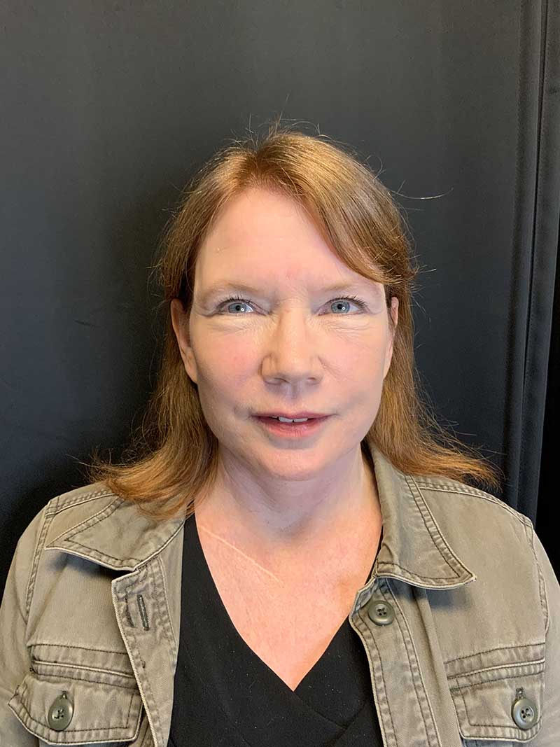 Facelift Before & After Image