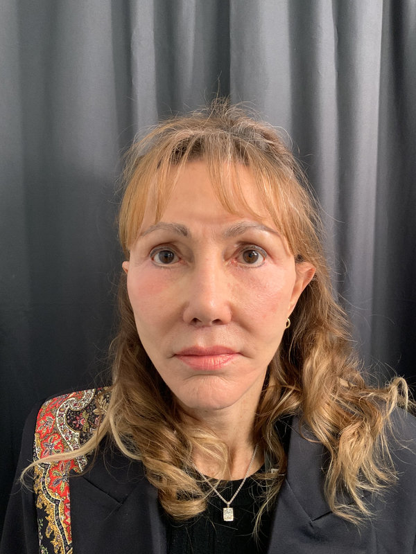 Facelift Before & After Image