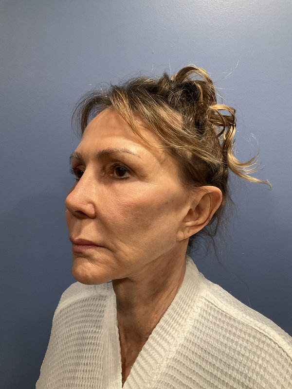 Facelift Before & After Image