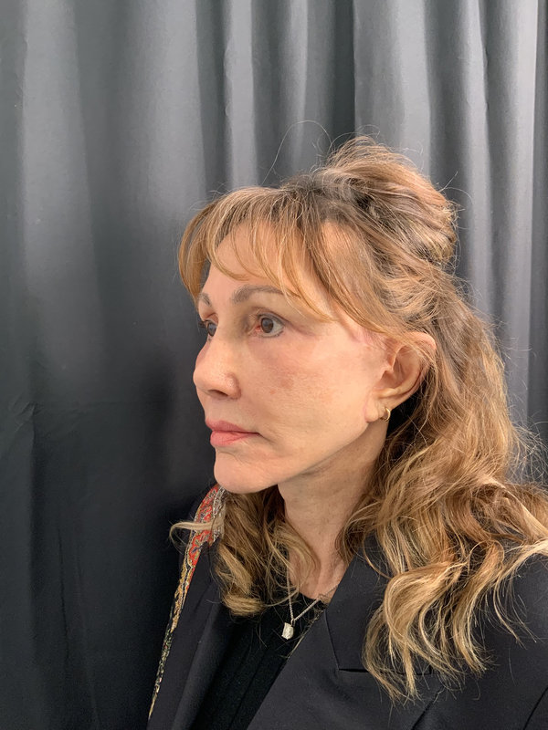 Facelift Before & After Image