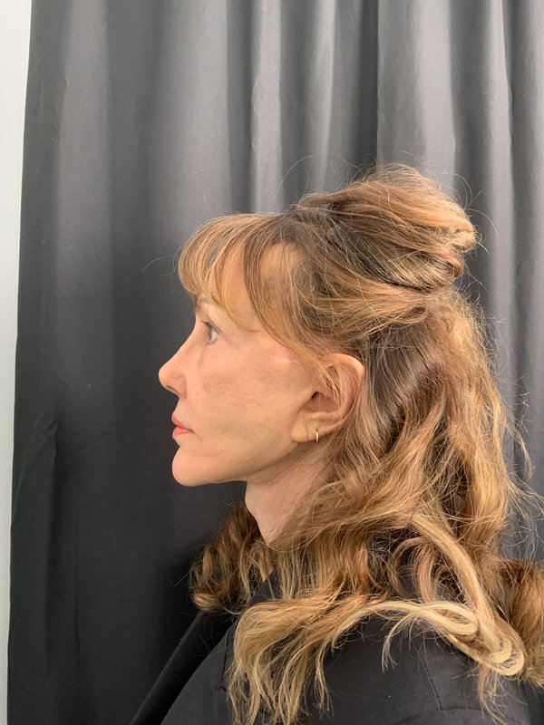 Facelift Before & After Image