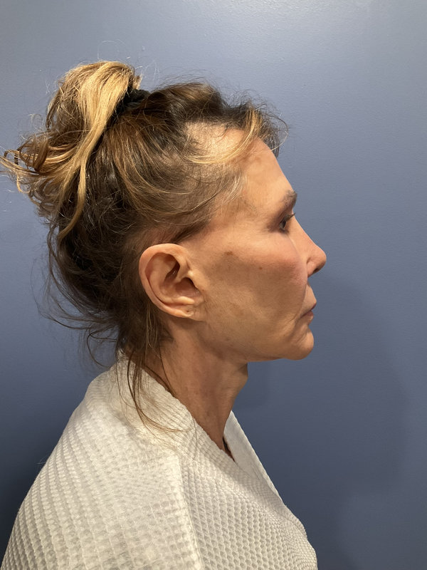 Facelift Before & After Image