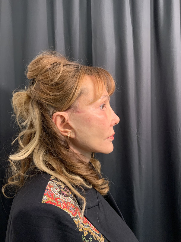 Facelift Before & After Image