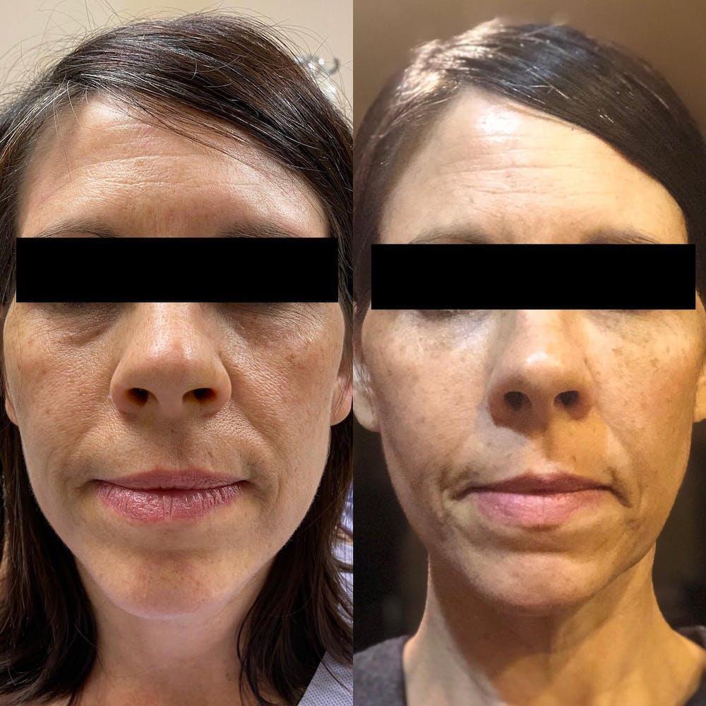 Facial Fat Transfer Before & After Image