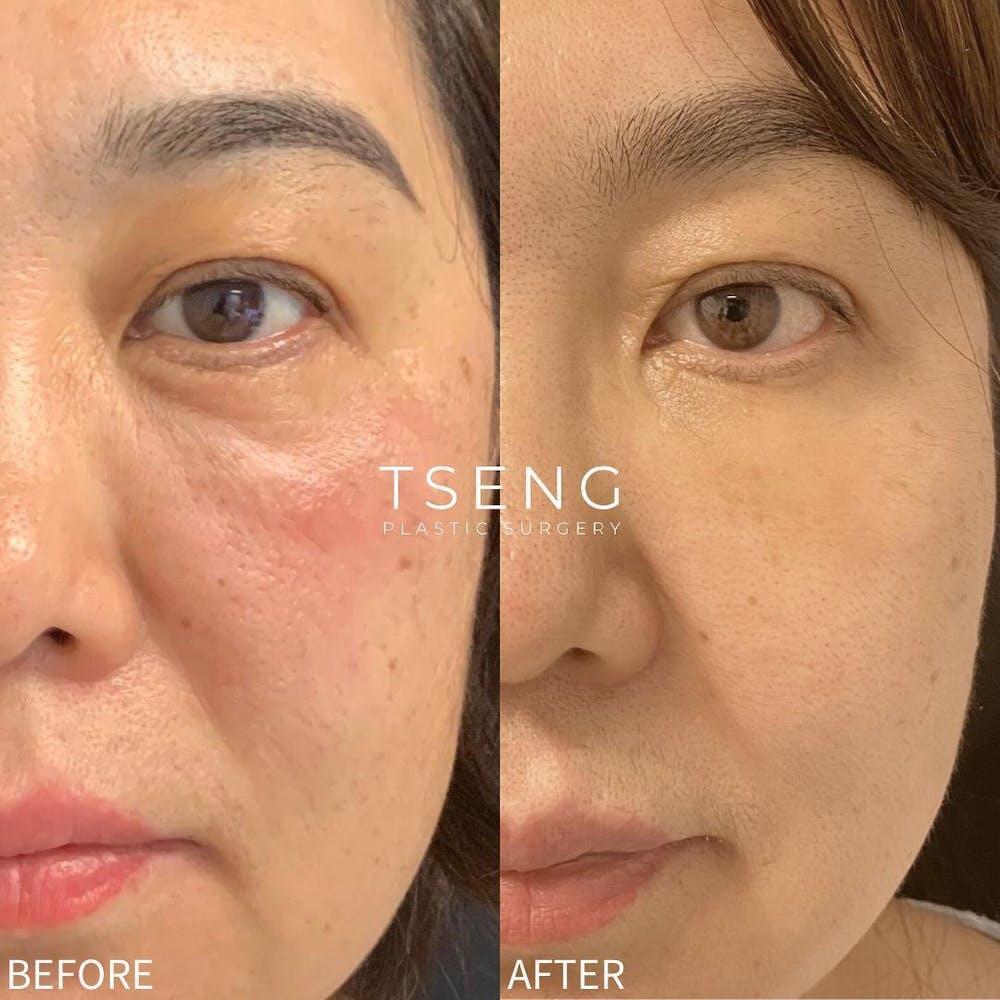 Facial Fat Transfer Before & After Image