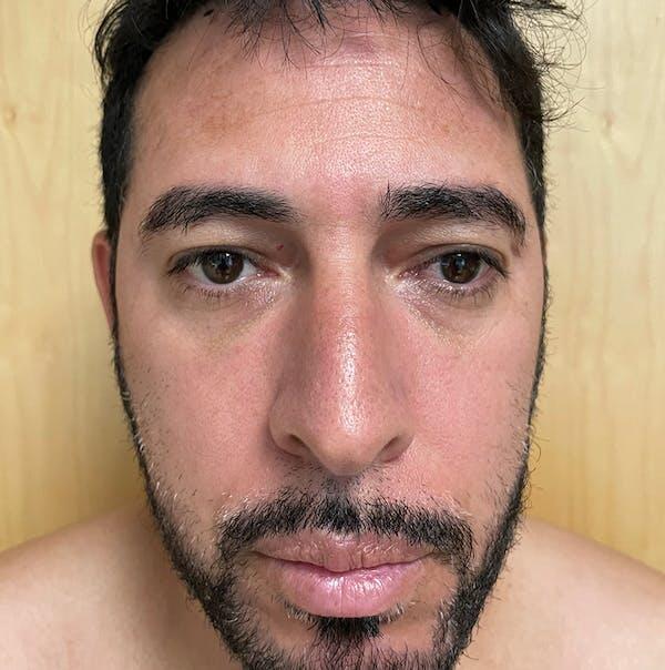 Facial Fat Transfer Before & After Image