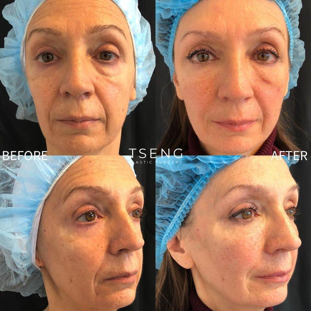 Facial Fat Transfer Before & After Image