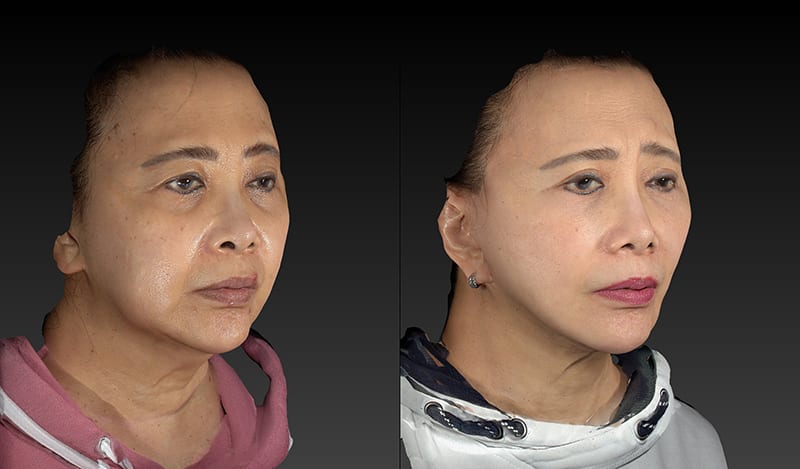 Facial Fat Transfer Before & After Image