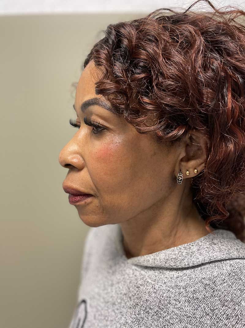 Facial Fat Transfer Before & After Image