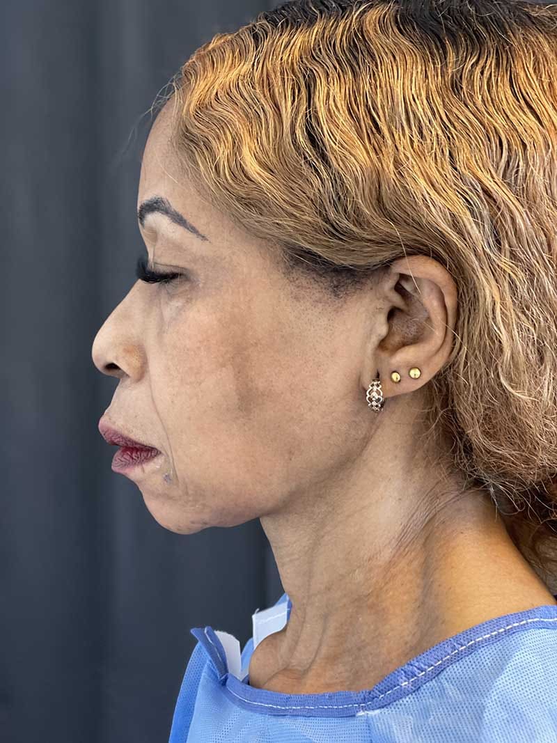 Facial Fat Transfer Before & After Image