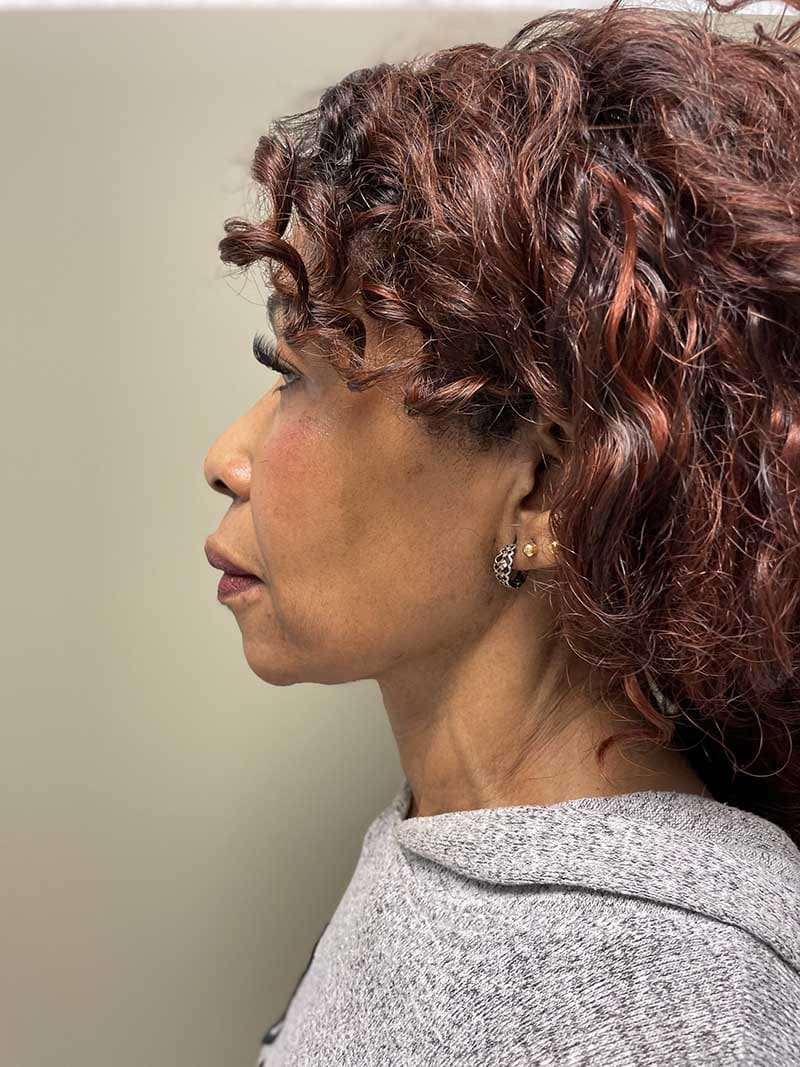 Facial Fat Transfer Before & After Image