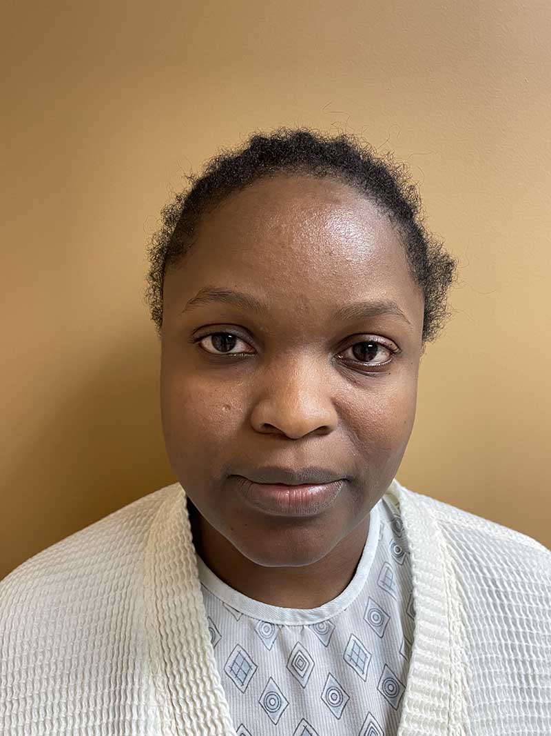 Facial Fat Transfer Before & After Image