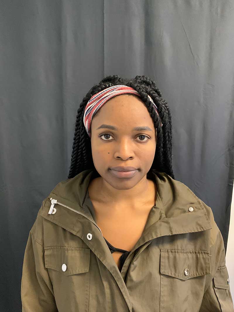 Facial Fat Transfer Before & After Image
