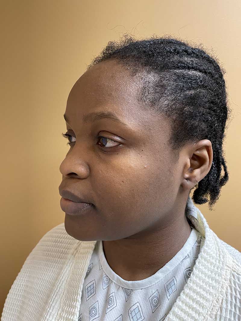 Facial Fat Transfer Before & After Image
