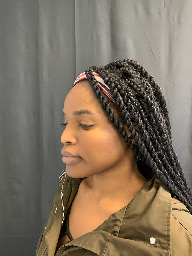Facial Fat Transfer Before & After Image