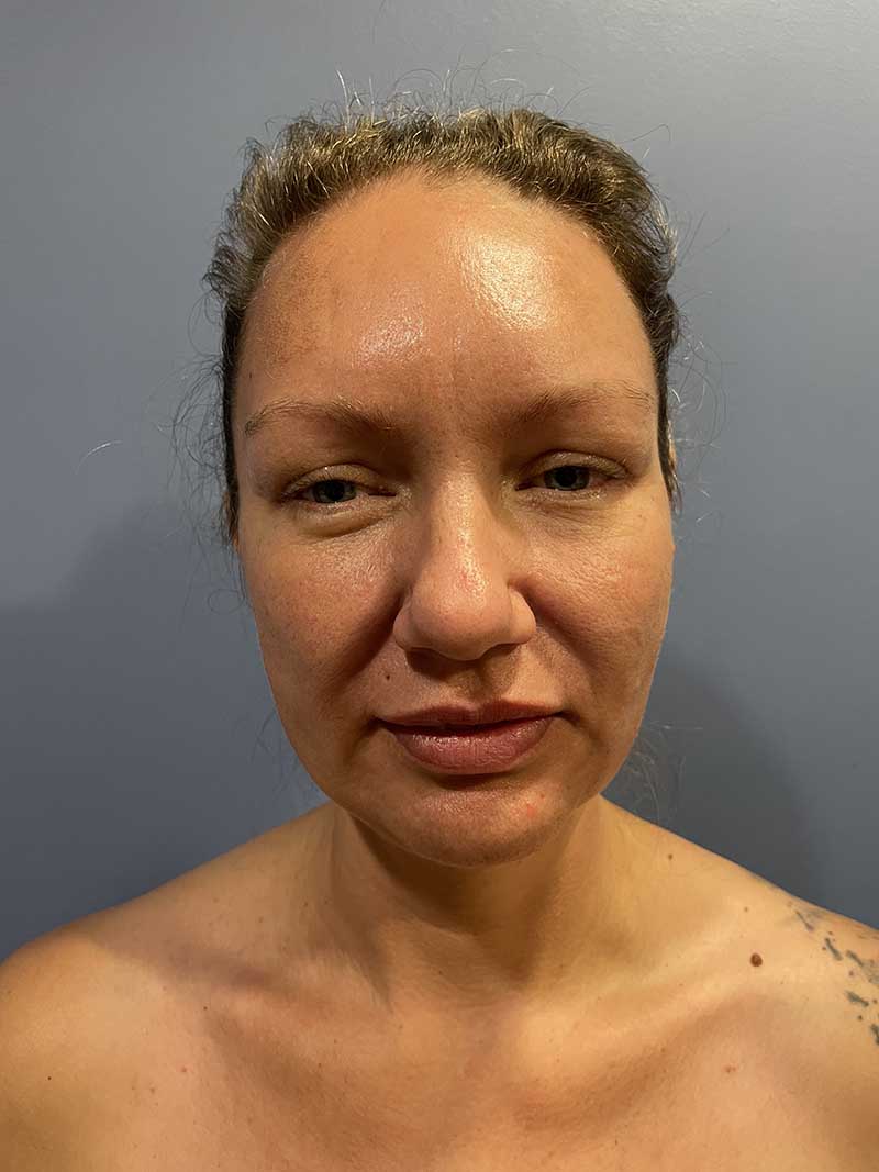 Facial Fat Transfer Before & After Image